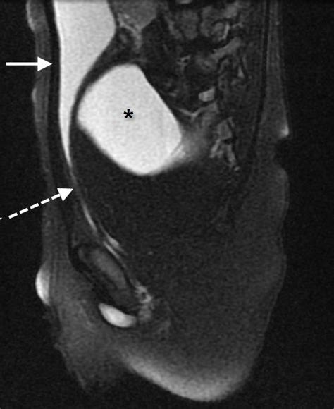 2-year-old male with an anorectal malformation and large anterior... | Download Scientific Diagram