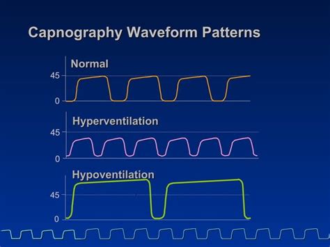 15 capnography part2 introduction