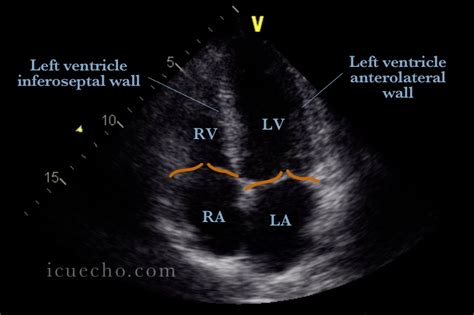 Apical 4 Chamber - ICU & Echo