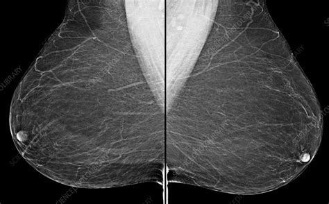 Normal mammogram - Stock Image - C036/6437 - Science Photo Library