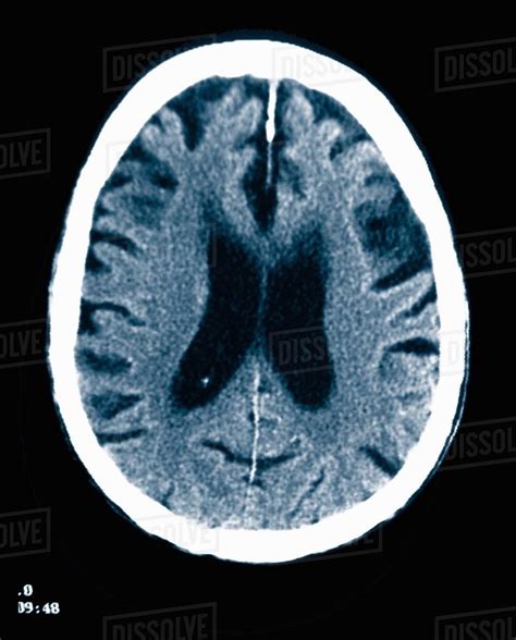 CT scan 84 year old male with Alzheimer's disease. CT shows brain ...