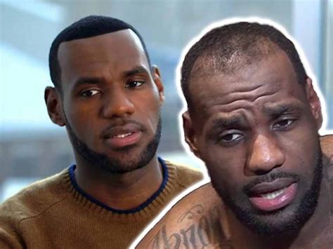 Lebron James Hair - Hair Transplant Analysis by Matt Dominance