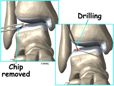 Osteochondritis Dissecans of the Talus - Orthopedic Surgery, Algonquin ...