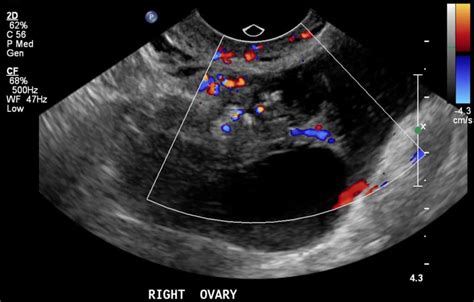 Pelvic Ultrasound Worksheet - Worksheets For Kindergarten