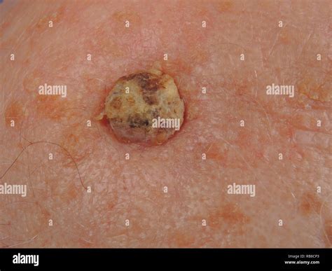 Epithelioma High Resolution Stock Photography and Images - Alamy