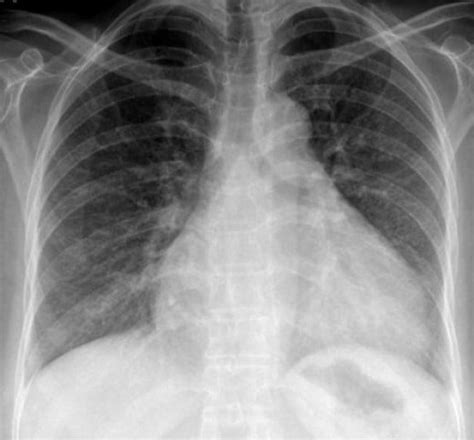 Fluid Around the Heart - Causes, Symptoms, Diagnosis, Treatment