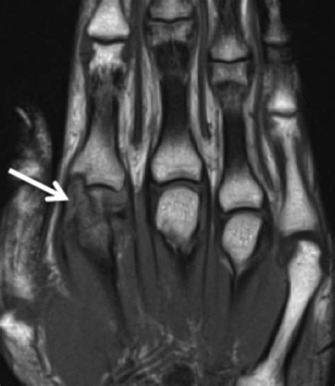 Why Do Your Fingers Make A “Pop” Noise When You Crack Your Knuckles ...