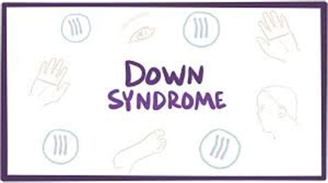 What is the best treatment for Down syndrome | mongolism disease | Down syndrome | down syndrome ...