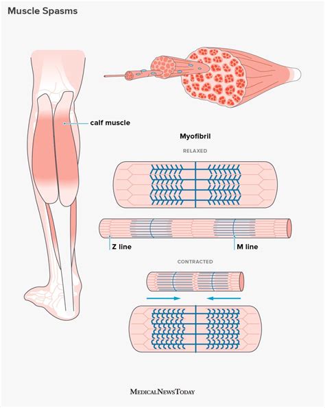 Muscle spasms: Causes, symptoms, and treatment