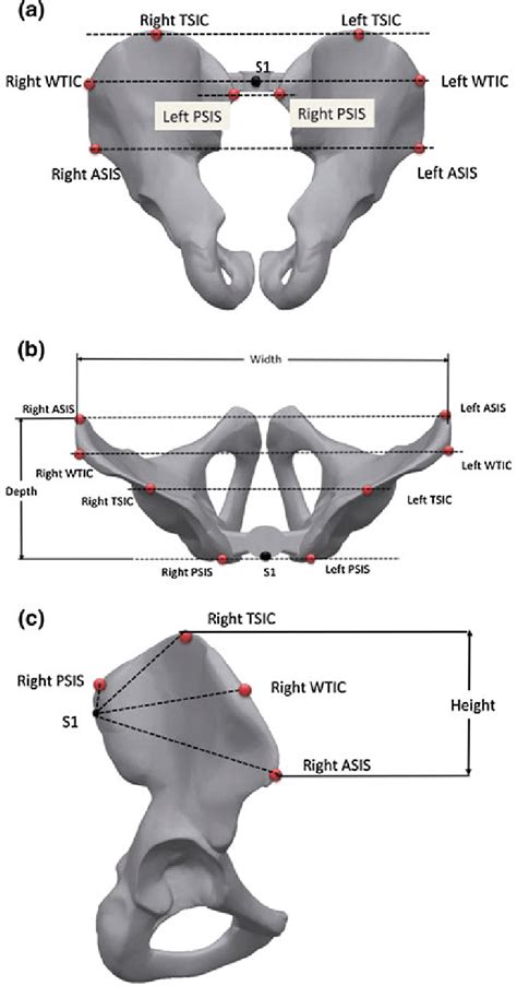 S1, PSIS, ASIS, TSIC and WTIC positions on the pelvis as well as the ...