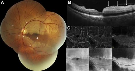 Central Retinal Artery Occlusion with Cilioretinal Artery Sparing ...