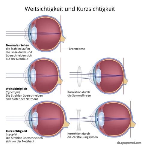 Weitsichtigkeit - Symptome