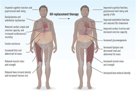 Growth hormone deficiency in adults with hypopituitarism—What are the ...