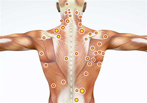 Trigger Point Injections - Cleveland Medical Institute