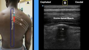 How to Perform an Erector Spinae Plane Block - ACEP Now