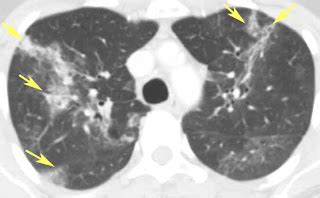 RiT radiology: Drug-Induced Eosinophilic Pneumonia