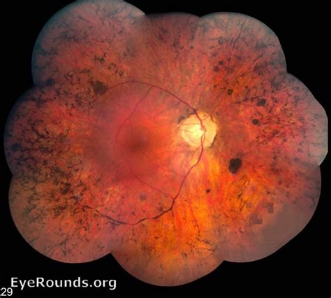 Retinitis pigmentosa (RP). EyeRounds.org: Online Ophthalmic Atlas