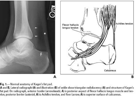 A 31 y.o. male comes in with bilateral heel pain. His xray is shown ...