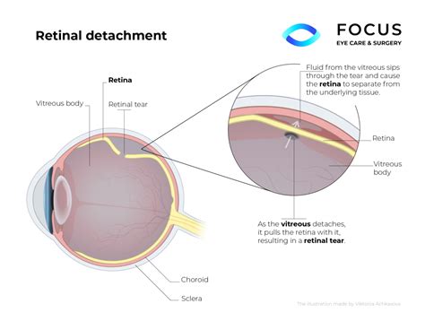 Retinal Detachment Queens NYC and Long Island NY