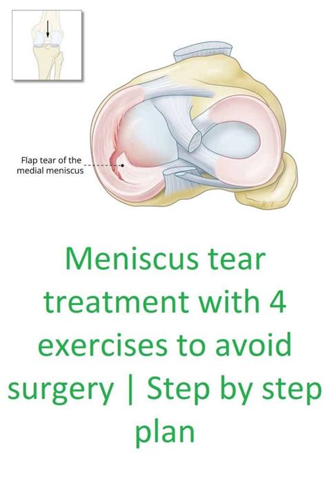 Meniscus tear cause, symptoms, and treatment with exercises