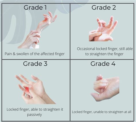 What is trigger finger - Teo Orthopaedic Specialist Clinic