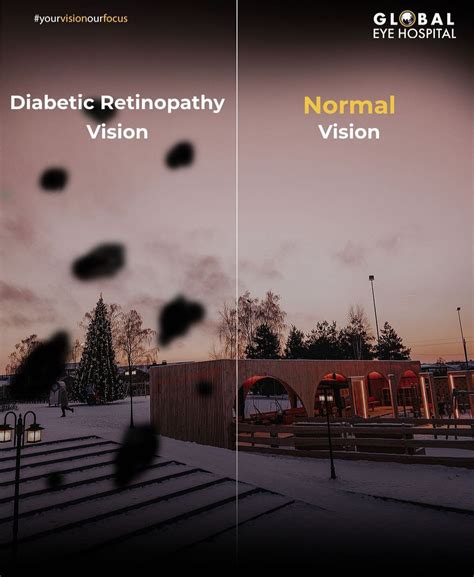 What are the types of diabetic retinopathy? - Global Eye Hospital