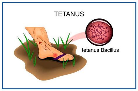 Tetanus - MEDizzy