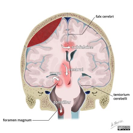 Tonsillar herniation | Radiology Reference Article | Radiopaedia.org