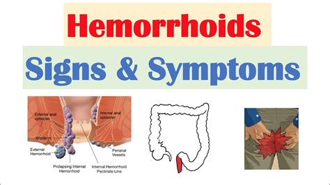 Just how are hemorrhoids detected? - Blog - My Gorgeous Web-blog