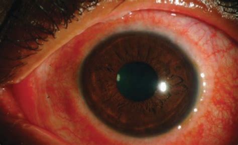 Lesson: Conjunctivitis: Know Your Differentials