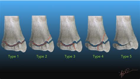 Salter-Harris Classification of Growth Plate Fractures | UW Emergency Radiology