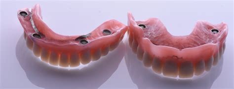 Implant retained denture - Ordinacija Cvejanovic