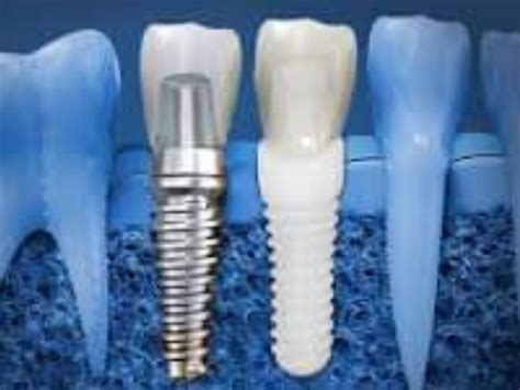 Dental Implants in Frisco TX | Dental implants, Best dental implants, Mini dental implants