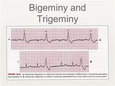 Ventricular Rhythms + Heart Blocks Flashcards | Quizlet