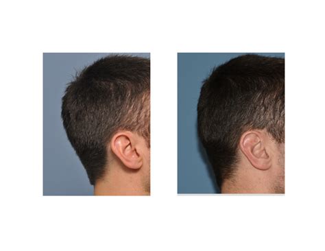 Plastic Surgery Case Study - Occipital Skull Reduction - Explore ...