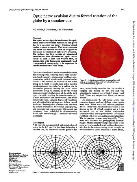 Optic Nerve Avulsion Due To Forced Rotation of The Globe by A Snooker ...