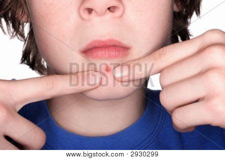 Picking Pimple Image & Photo (Free Trial) | Bigstock