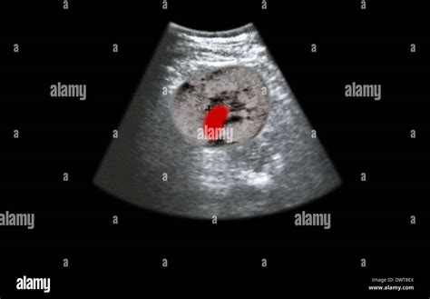 Kidney stone ultrasound scan Stock Photo - Alamy