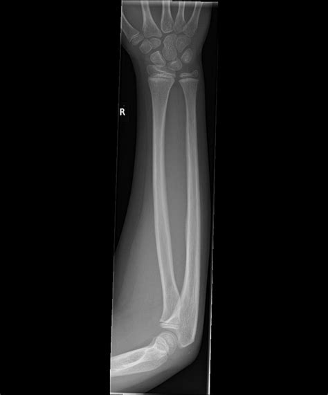 Normal Forearm X Ray