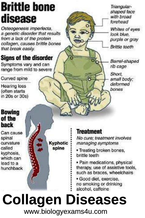 Example of Collagen diseases