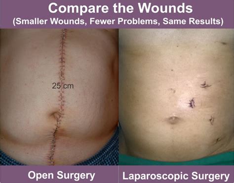 What are the advantages of laparoscopy versus open surgery?