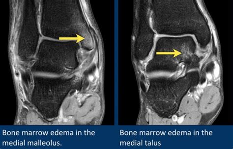 Deltoid Ligament Ankle Mri