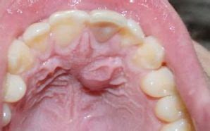 Roof of Mouth Hurts: Causes and Treatment | IYTmed.com