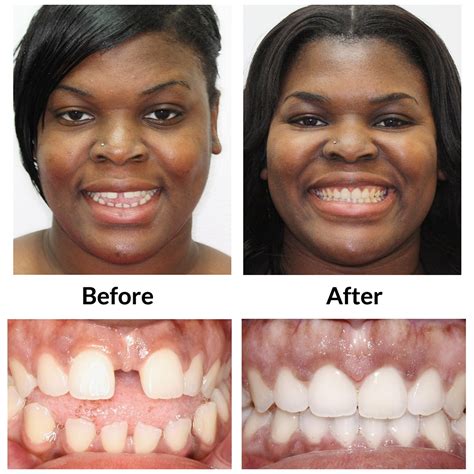 Invisalign in Enterprise | TW Orthodontics | Andalusia Invisalign | Montgomery | Selma ...