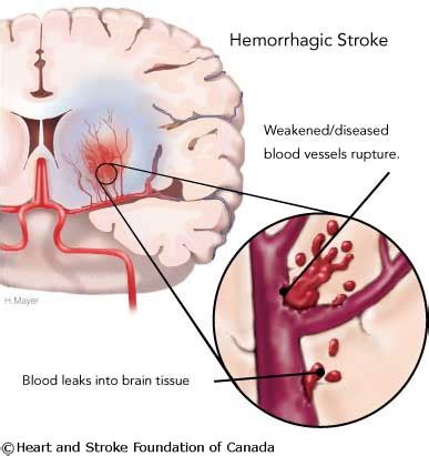 75 best images about Hemorrhagic Stroke on Pinterest | Mouth sores ...