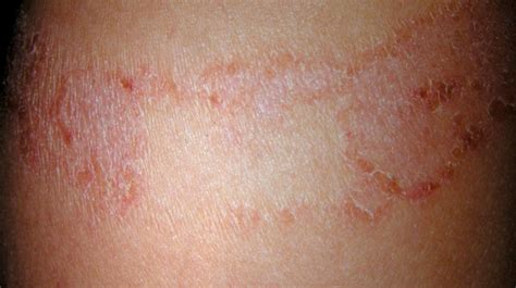 Itching (Pruritis): Pictures, Causes, Remedies, and More