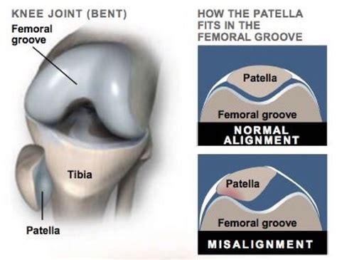 18 best Patellar Tracking Disorder images on Pinterest | Workouts, Physical therapy and Exercise ...