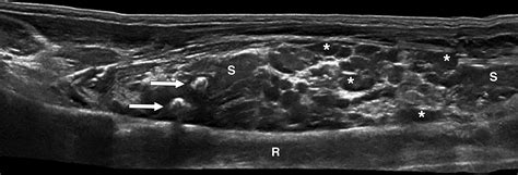 Ultrasound Evaluation of Pediatric Slow-Flow Vascular Malformations: Practical Diagnostic ...