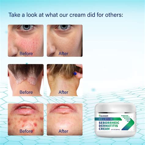 Seborrheic Dermatitis Face Cream