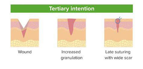 Tertiary intention of wound healing - MEDizzy